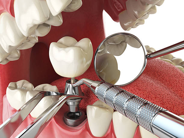 Best Emergency Root Canal Treatment in Sierra Ridge, CO